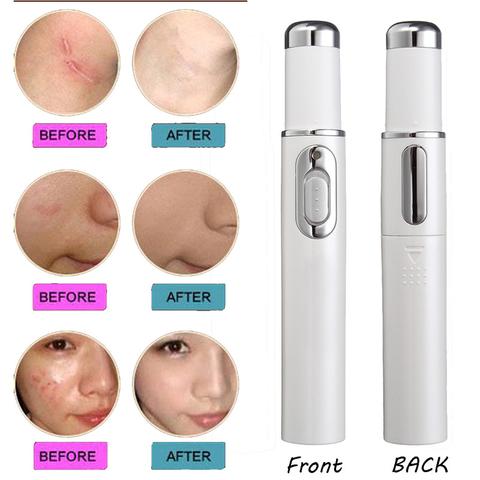 Blue Light Therapy Laser olovka za lice